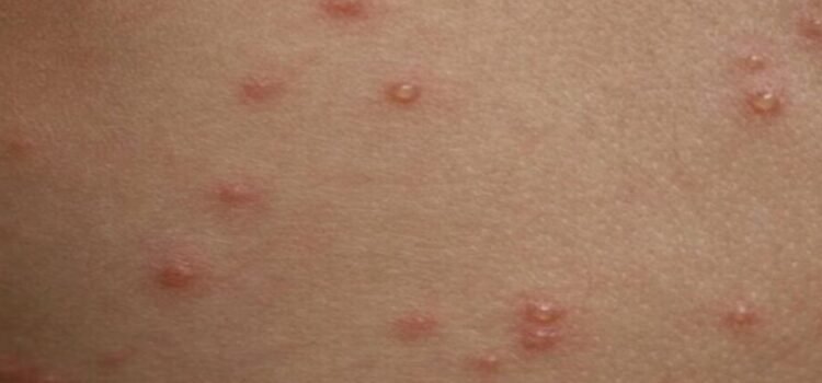 Casos de varicela en Edomex reportados durante noviembre Casos de varicela en Edomex reportados durante noviembre