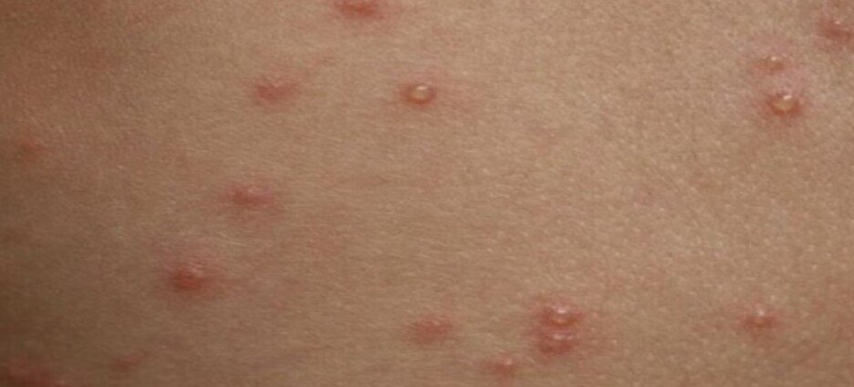 Casos de varicela en Edomex reportados durante noviembre