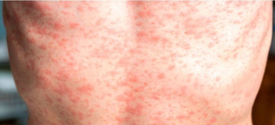 Incrementan a 66 los casos de sarampión en Edomex